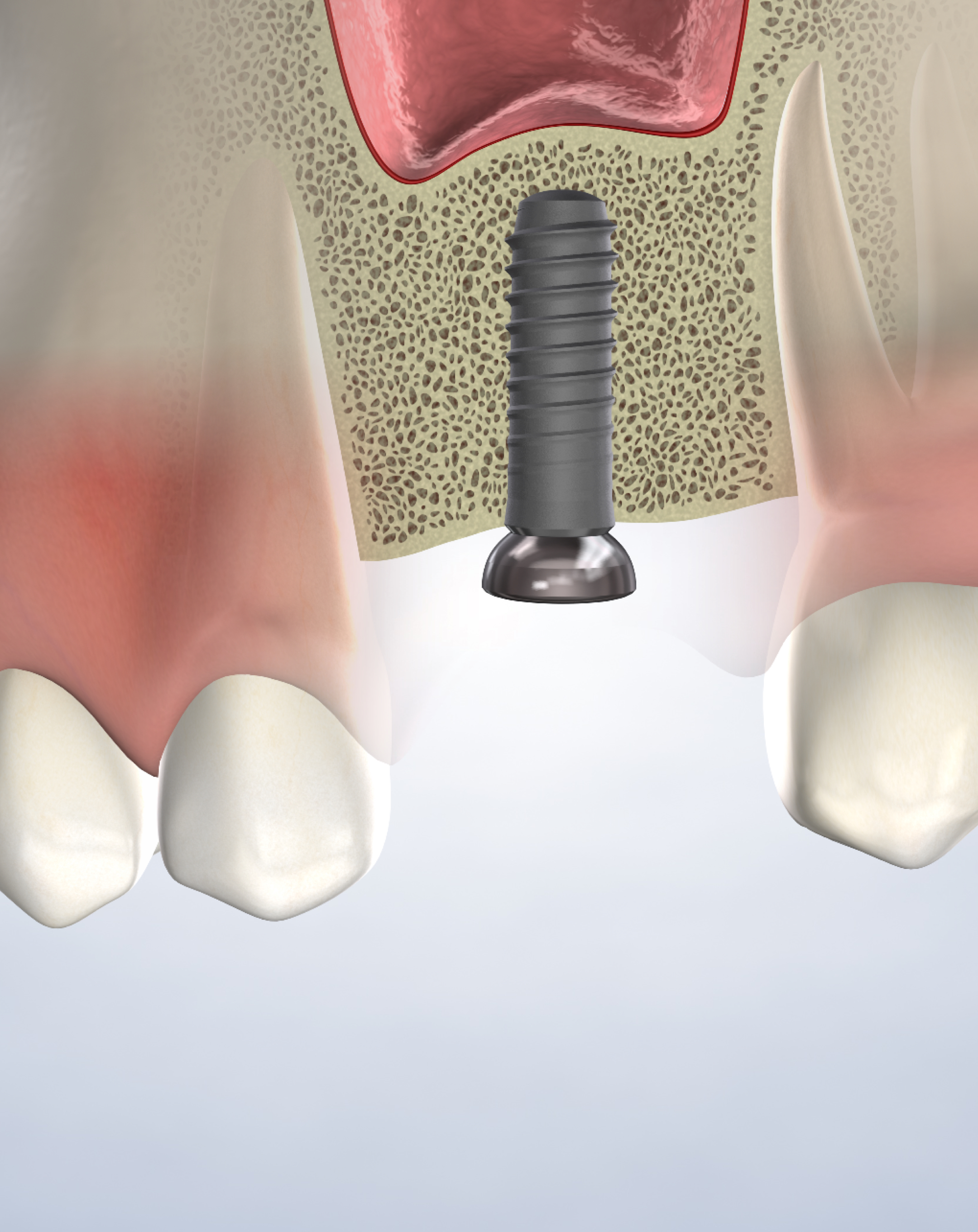 Bone grafting in Louisville and Mt. Washington, KY, and Jeffersonville, IN