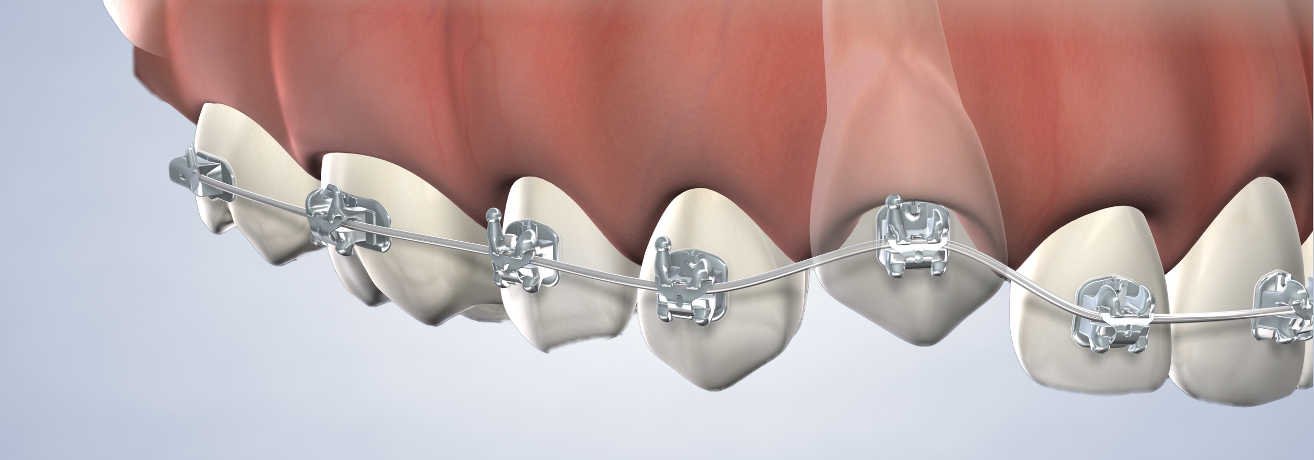 Impacted tooth exposure in Louisville and Mt. Washington, KY, and Jeffersonville, IN