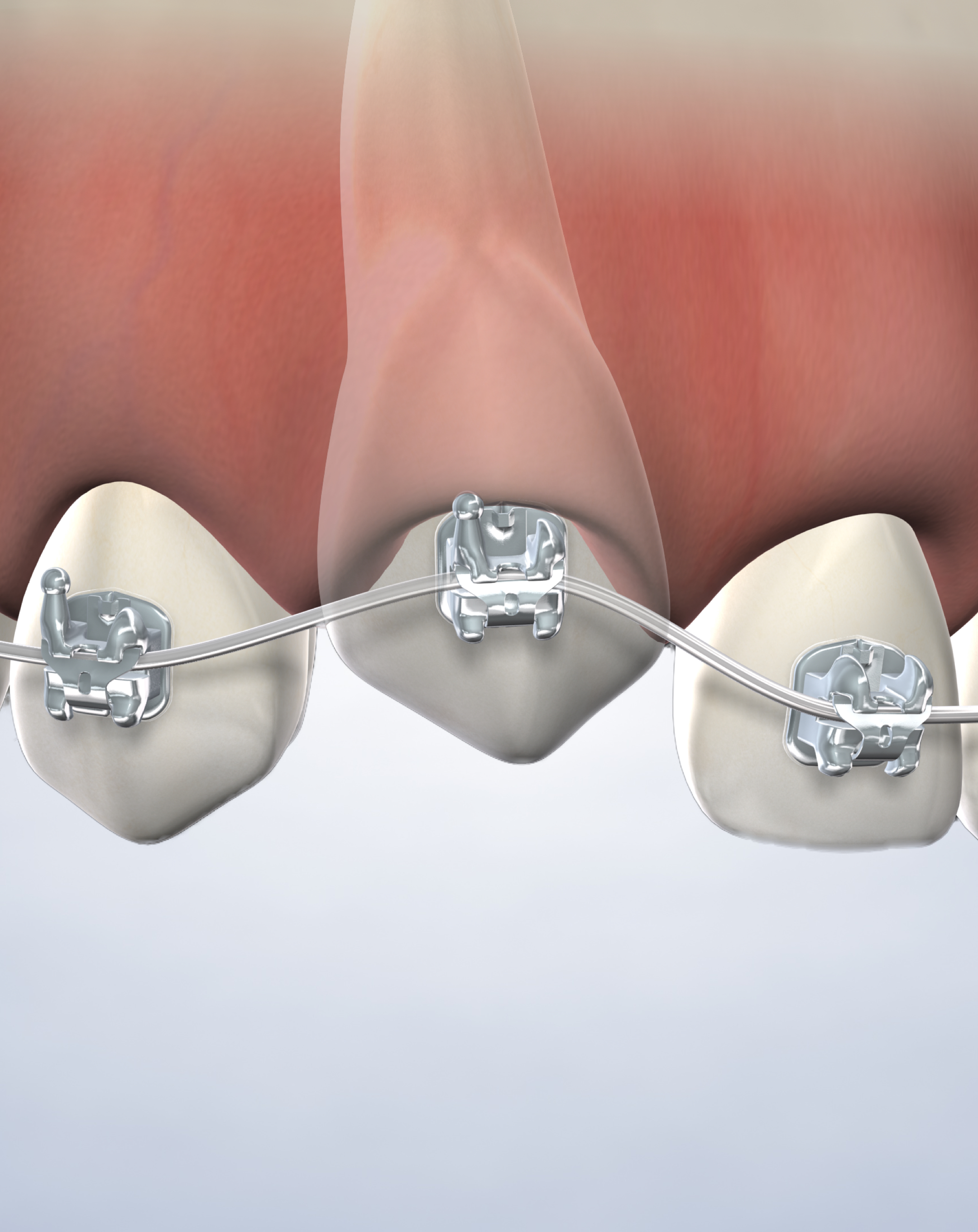 Impacted tooth exposure in Louisville and Mt. Washington, KY, and Jeffersonville, IN