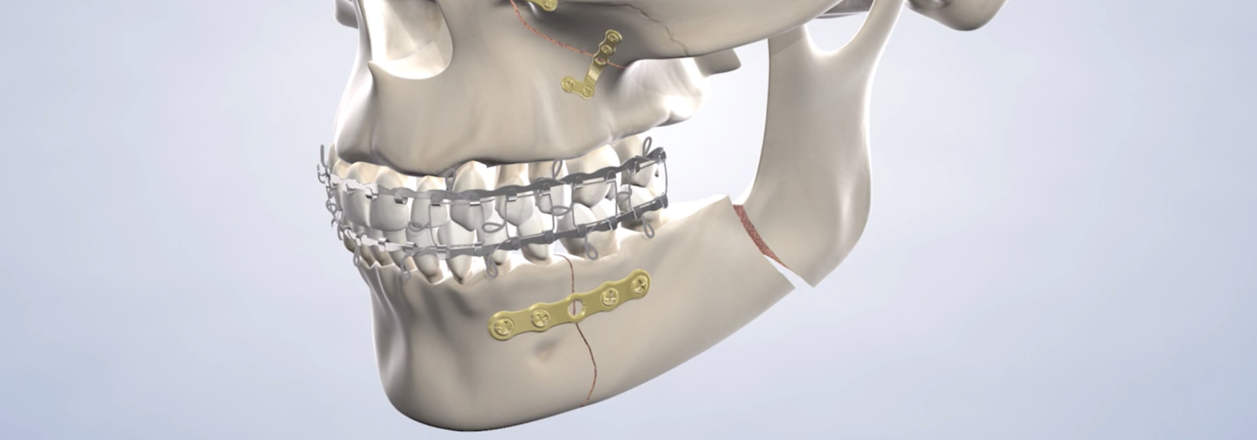 Facial trauma treatment in Louisville and Mt. Washington, KY, and Jeffersonville, IN