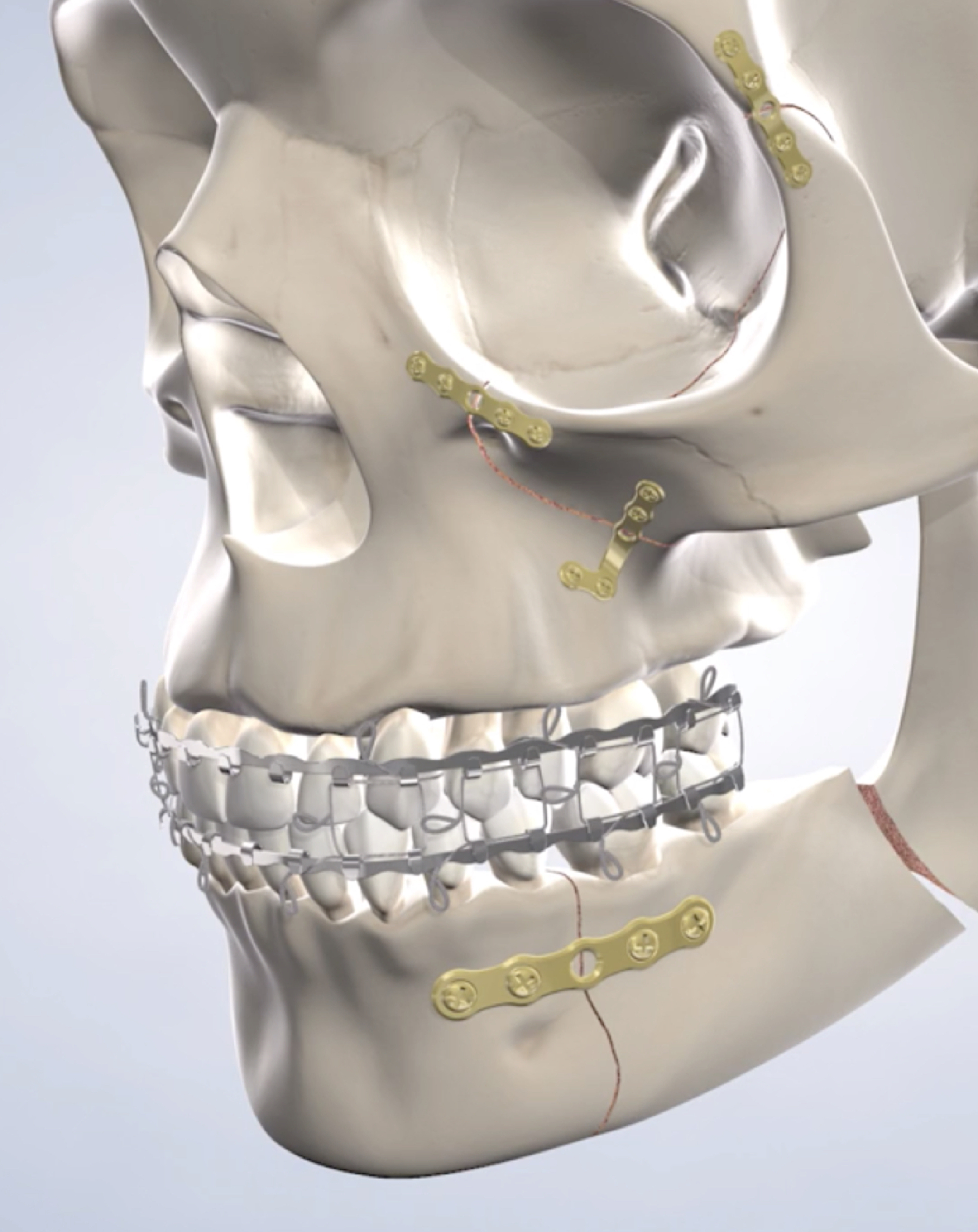 Facial trauma treatment in Louisville and Mt. Washington, KY, and Jeffersonville, IN