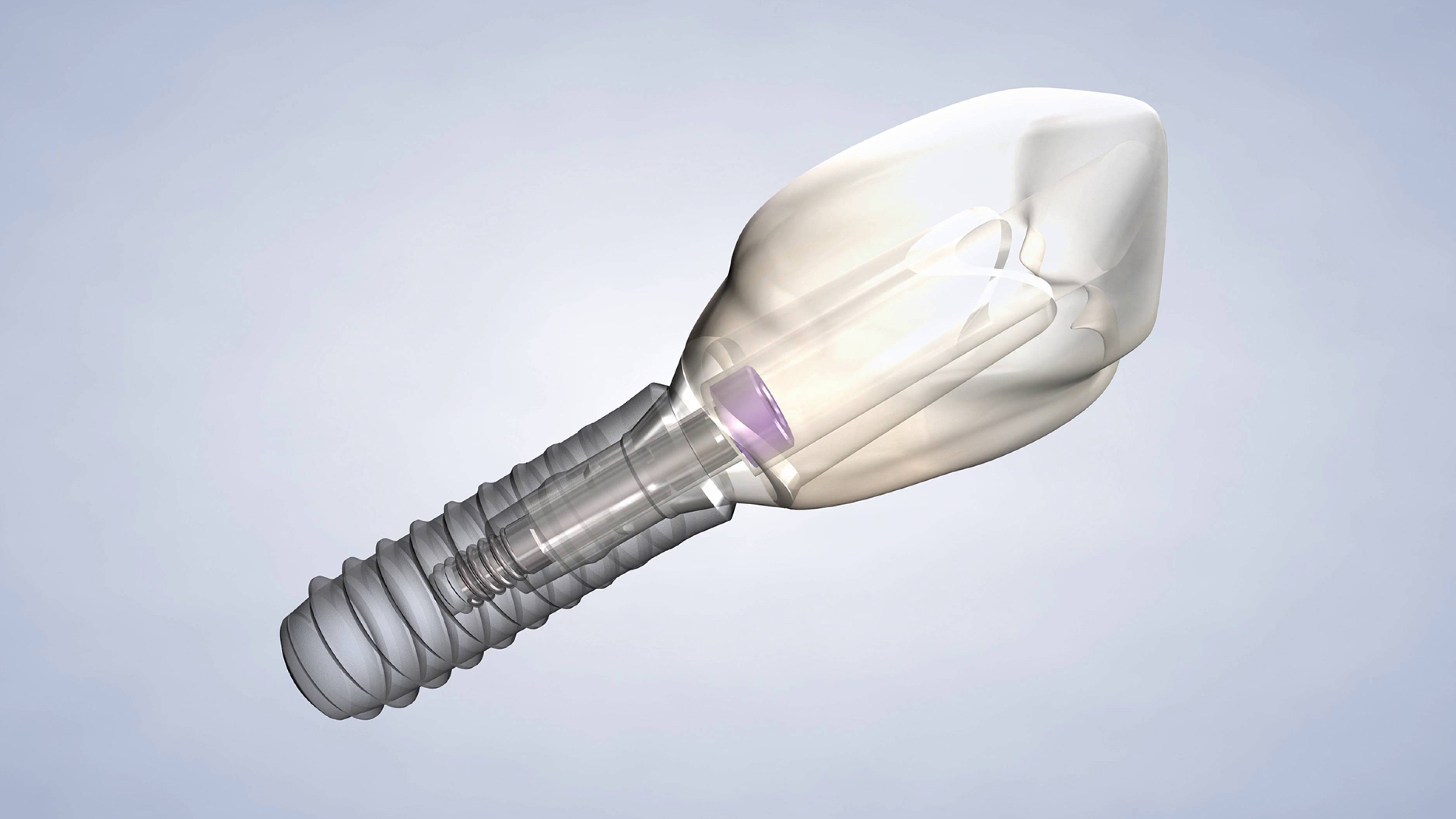 Dental Implants, post operative instructions