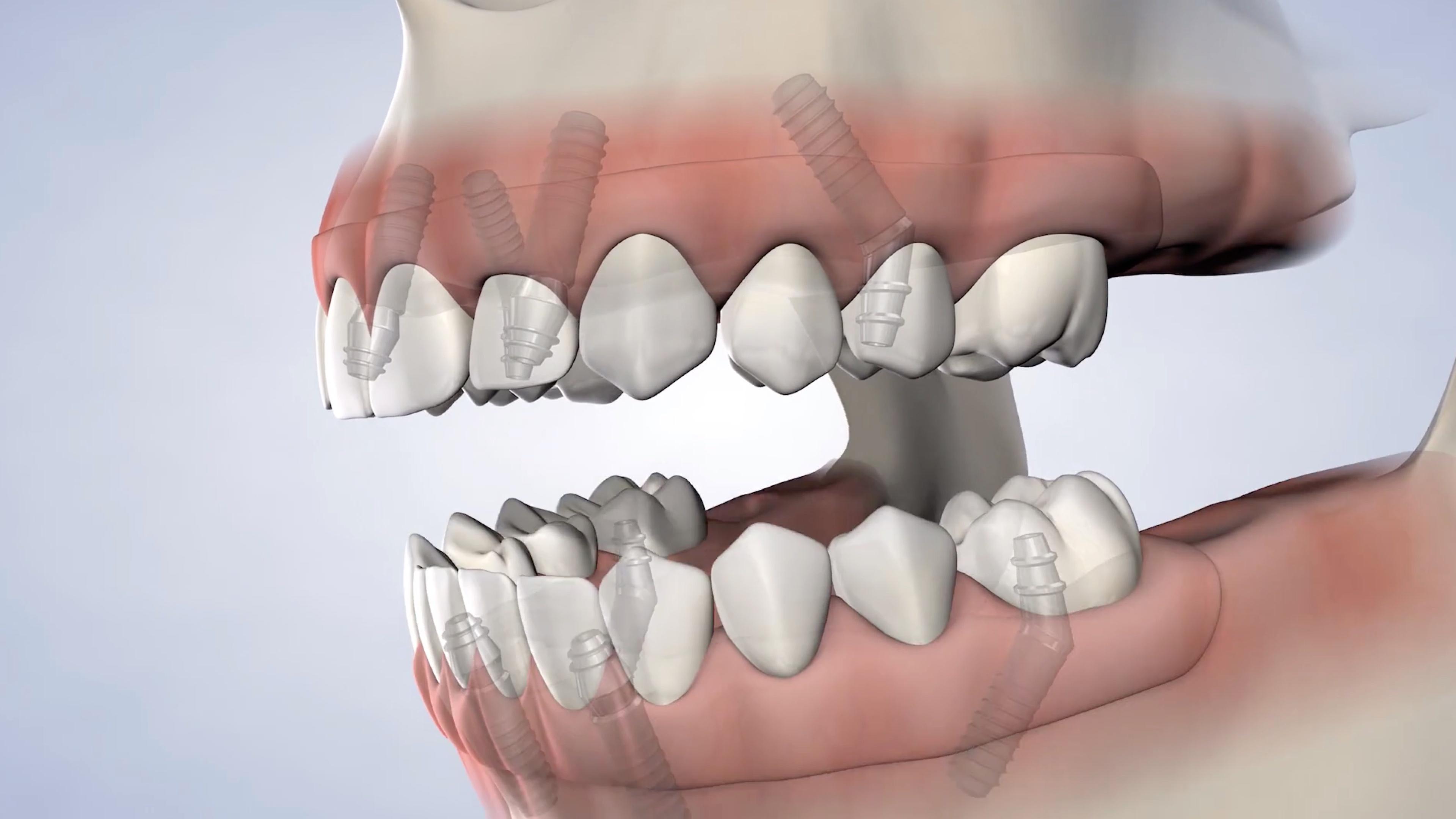 KOMS/DEV/instructions post-operation-full-arch