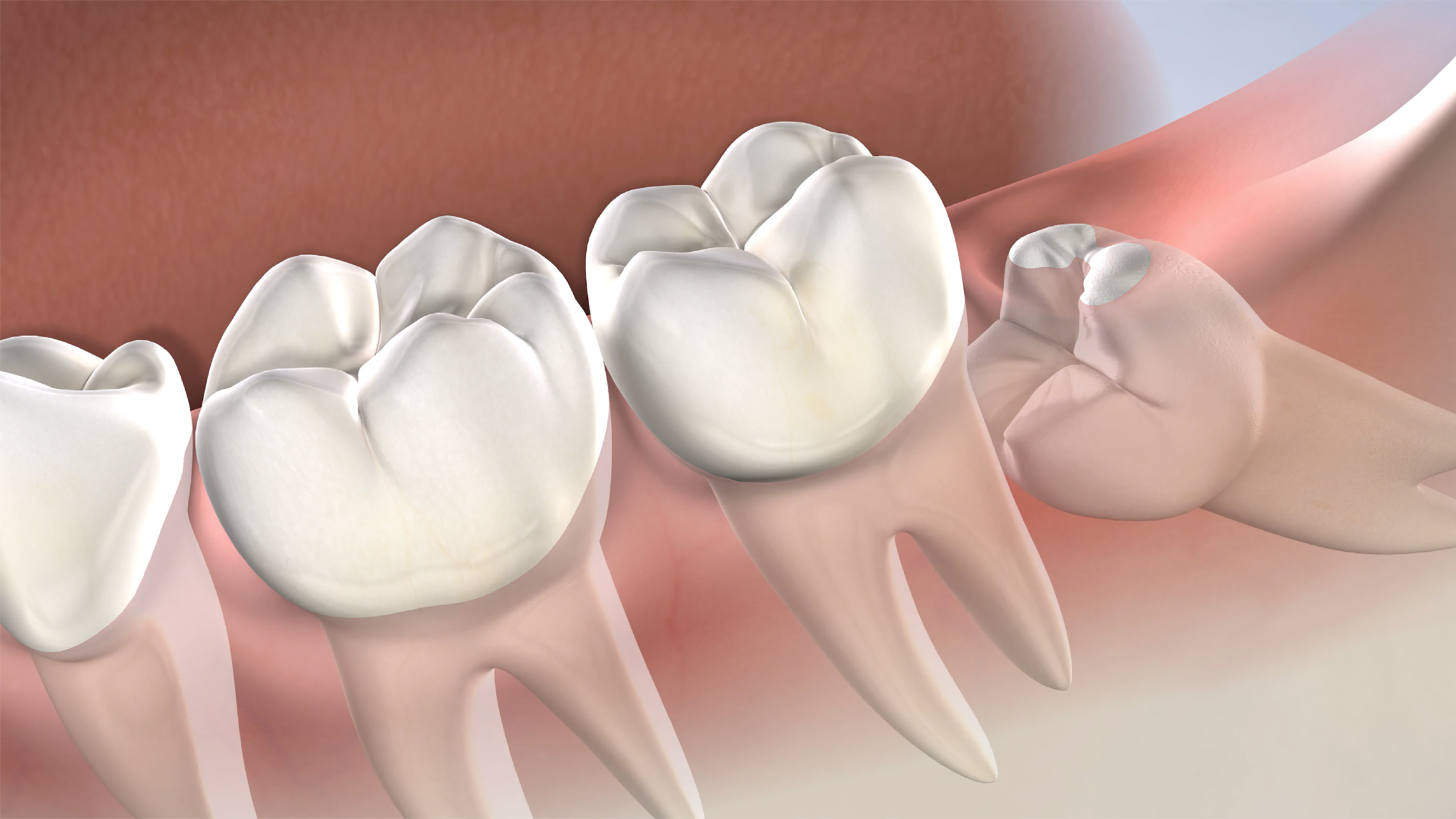 Wisdom teeth removal post-operative instructions