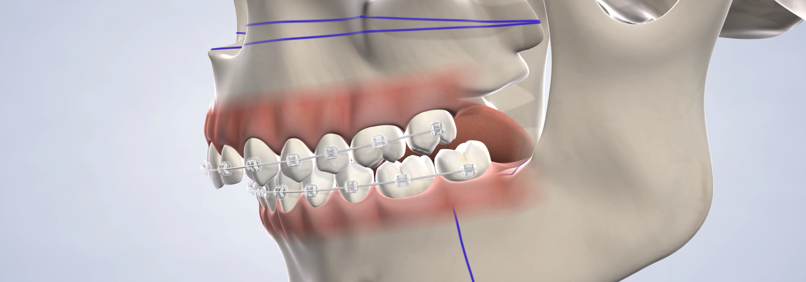 Corrective jaw surgery inLouisville and Mt. Washington, KY, and Jeffersonville, IN