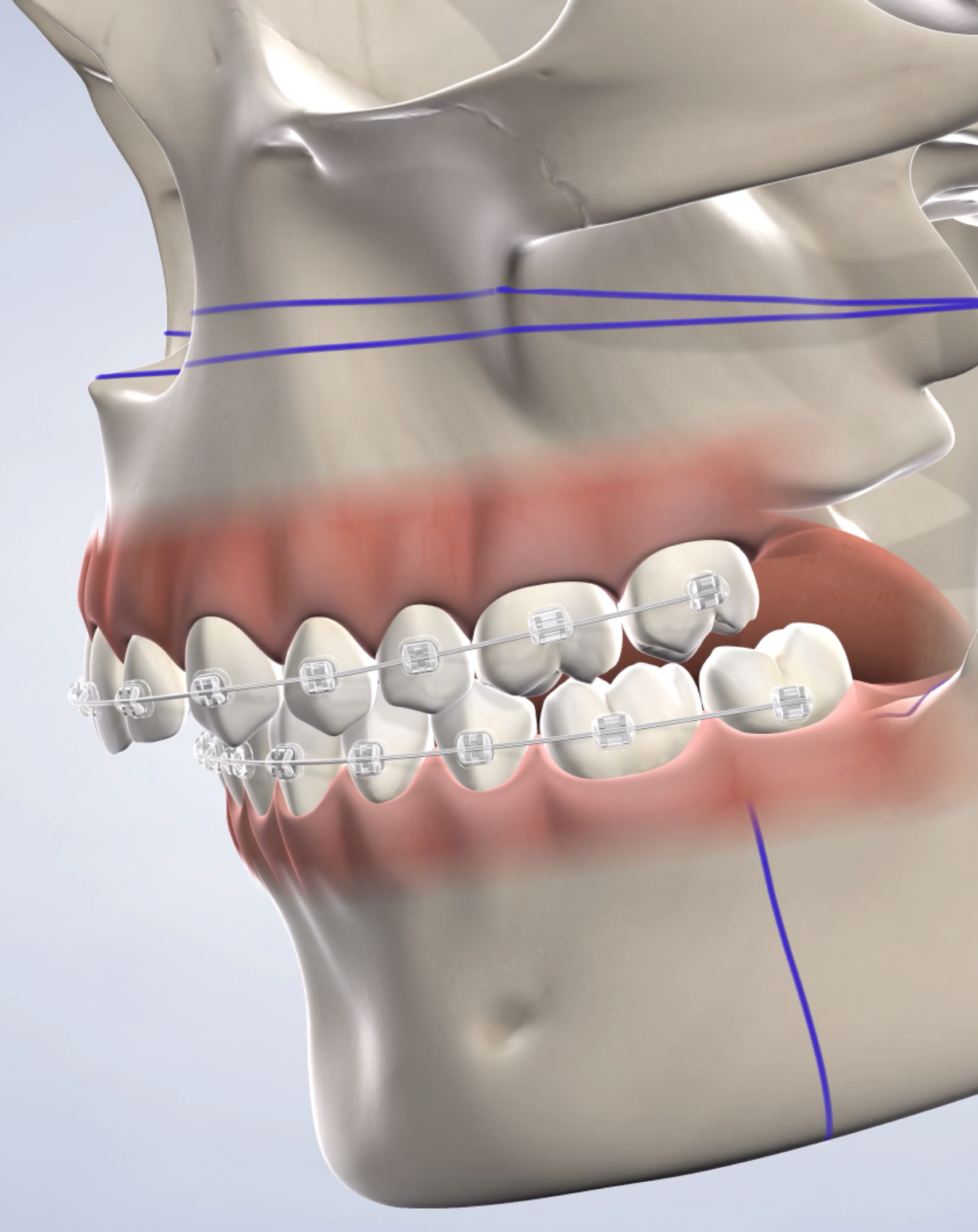 Corrective jaw surgery in Louisville and Mt. Washington, KY, and Jeffersonville, IN